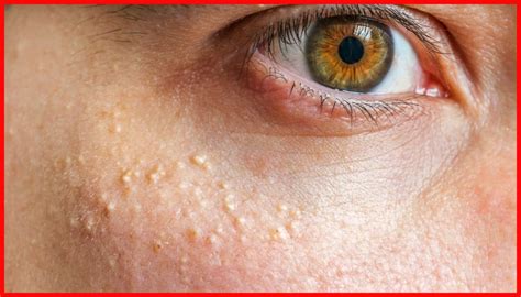 grains de fordyces|What they are, Causes, Symptoms and Treatments